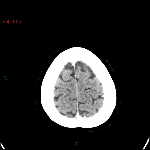 Azygos anterior cerebral artery (Radiopaedia 51987-57833 A 53).jpg