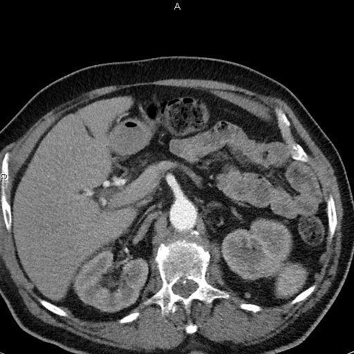 File:Azygos continuation of the inferior vena cava (Radiopaedia 18537-18404 C+ arterial phase 62).jpg