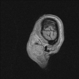 Balo concentric sclerosis (Radiopaedia 50458-55940 Sagittal T1 18).jpg