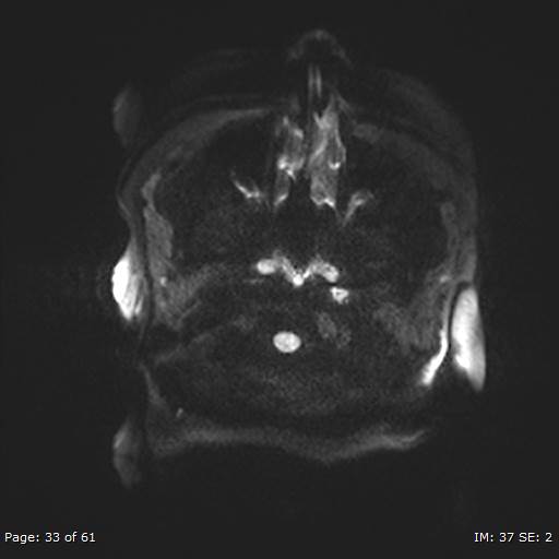 Balo concentric sclerosis (Radiopaedia 61637-69636 Axial DWI 33).jpg