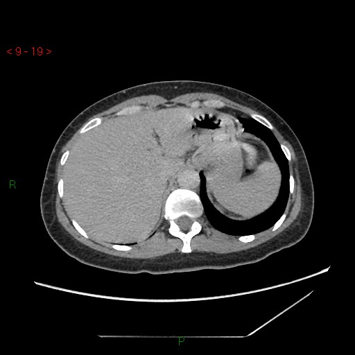 File:Bartholin gland cyst (Radiopaedia 54904-61181 Axial C+ delayed 5).jpg
