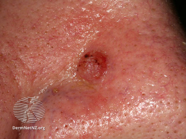 File:Basal cell carcinoma affecting the nose (DermNet NZ lesions-bcc-nose-0656).jpg
