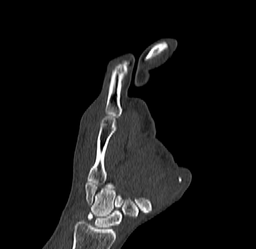 Base of 2nd metacarpal fracture (Radiopaedia 73741-84544 Coronal bone window 47).jpg