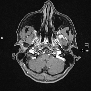 Basilar artery perforator aneurysm (Radiopaedia 82455-99523 G 5).jpg