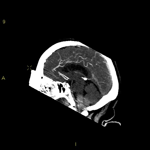 File:Basilar artery thrombosis (Radiopaedia 14772).jpg