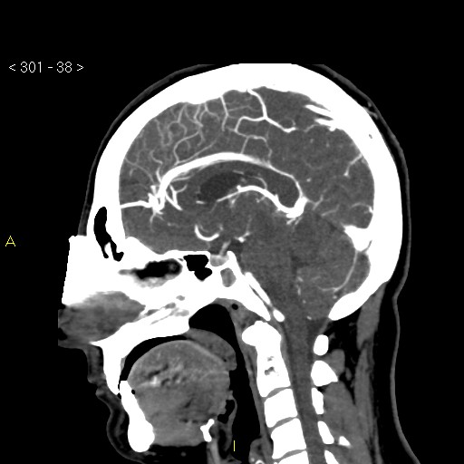 File:Basilar artery thrombosis (Radiopaedia 16260-15944 C 32).jpg