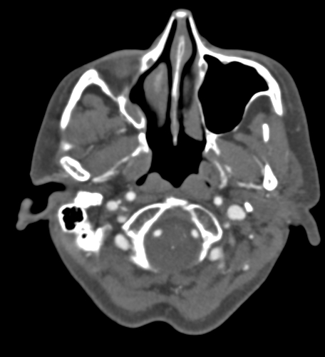 Basilar tip aneurysm with coiling (Radiopaedia 53912-60086 A 18).jpg