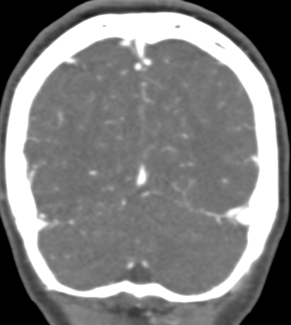 Basilar tip aneurysm with coiling (Radiopaedia 53912-60086 B 130).jpg