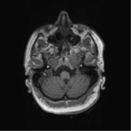 Behavioral variant frontotemporal dementia and late onset schizophrenia (Radiopaedia 52197-58083 Axial T1 95).png