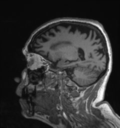 Behavioral variant frontotemporal dementia and late onset schizophrenia (Radiopaedia 52197-58083 Sagittal T1 28).png
