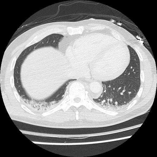 Benign post-traumatic pseudopneumoperitoneum (Radiopaedia 71199-81495 Axial lung window 53).jpg