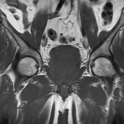 File:Benign prostatic nodular hyperplasia (Radiopaedia 16917-16634 Coronal T1 9).jpg