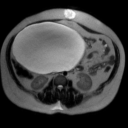 File:Benign seromucinous cystadenoma of the ovary (Radiopaedia 71065-81300 Axial T2 6).jpg