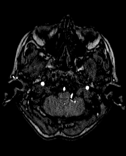 Berry aneurysm of the terminal internal carotid artery (Radiopaedia 88286-104918 Axial TOF 54).jpg