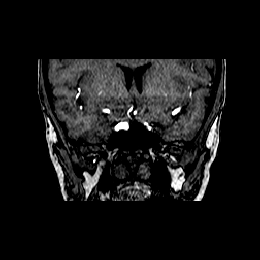 File:Berry aneurysm of the terminal internal carotid artery (Radiopaedia 88286-104918 Coronal TOF 30).jpg
