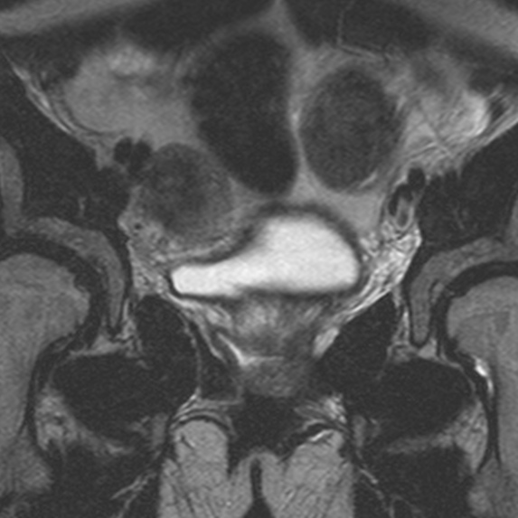 File:Bicornuate uterus (Radiopaedia 24677-24949 Coronal T2 2).jpg