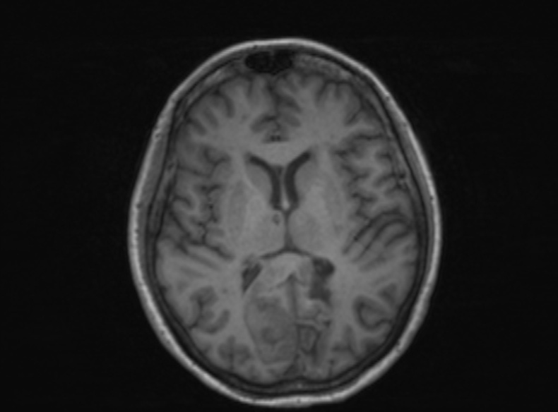 Bilateral PCA territory infarction - different ages (Radiopaedia 46200-51784 Axial T1 224).jpg