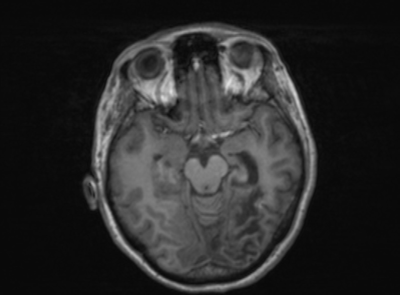 Bilateral PCA territory infarction - different ages (Radiopaedia 46200-51784 Axial T1 267).jpg
