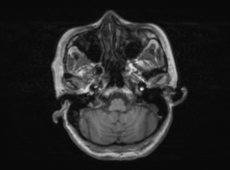 Bilateral PCA territory infarction - different ages (Radiopaedia 46200-51784 Axial T1 322).jpg