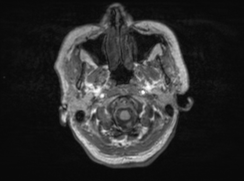 File:Bilateral PCA territory infarction - different ages (Radiopaedia 46200-51784 Axial T1 351).jpg