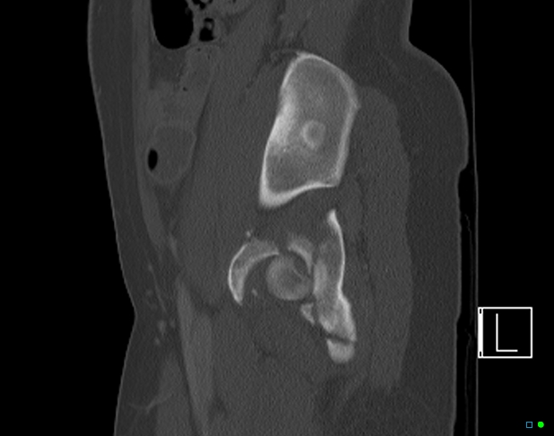 File:Bilateral acetabular fractures (Radiopaedia 79272-92308 Sagittal bone window 65).jpg