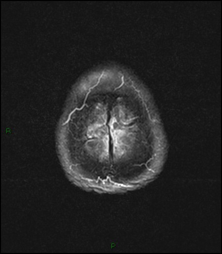 File:Bilateral acute middle cerebral artery territory infarcts (Radiopaedia 77319-89402 Axial FLAIR 23).jpg
