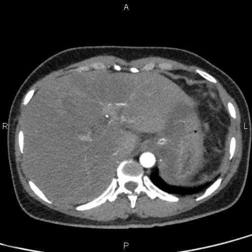 Bilateral adrenal gland hyperenhancement in pancreatitis (Radiopaedia 86642-102753 B 19).jpg