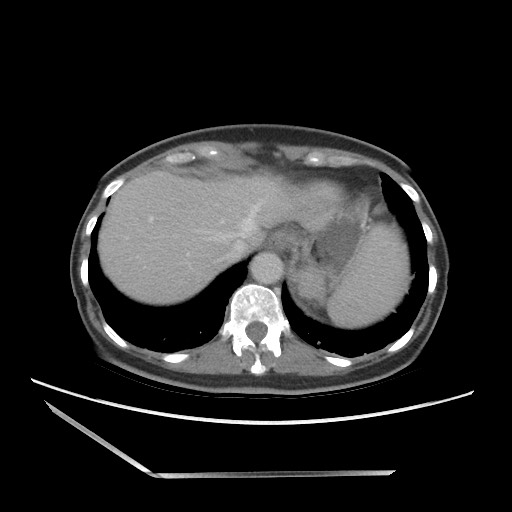 Bilateral adrenal granulocytic sarcomas (chloromas) (Radiopaedia 78375-91007 A 20).jpg
