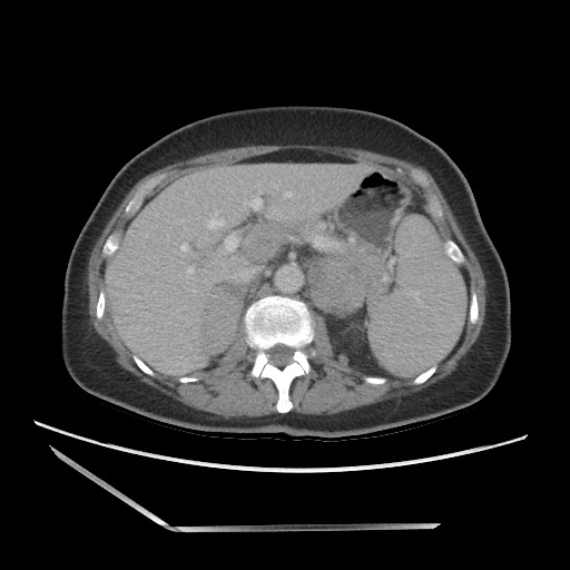File:Bilateral adrenal granulocytic sarcomas (chloromas) (Radiopaedia 78375-91007 A 37).jpg