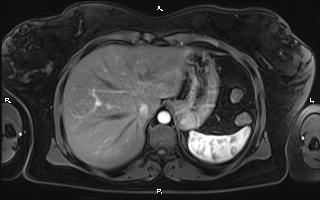 File:Bilateral adrenal myelolipoma (Radiopaedia 63058-71537 Axial T1 C+ fat sat 21).jpg