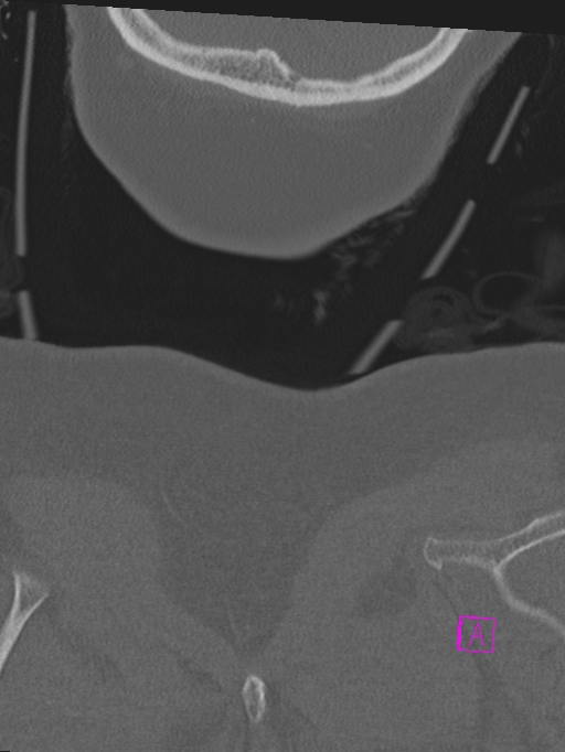 Bilateral atlanto-occipital assimilation (Radiopaedia 28350-28603 Coronal bone window 63).jpg