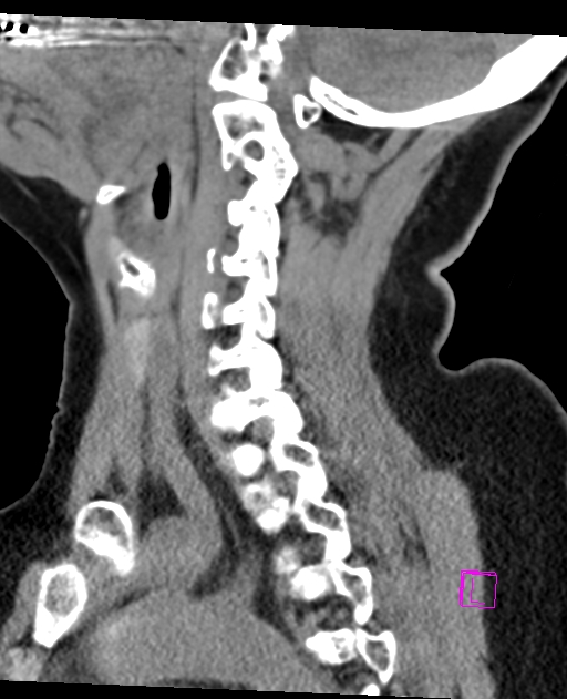 Bilateral atlanto-occipital assimilation (Radiopaedia 28350-28603 D 30).jpg