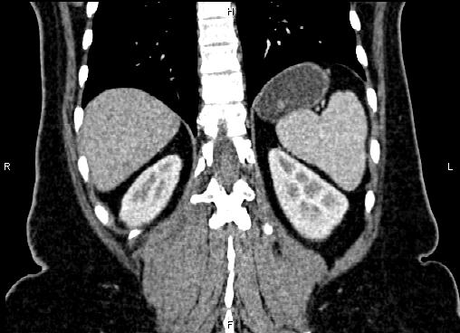 Bilateral benign adrenal adenomas (Radiopaedia 86912-103124 D 51).jpg
