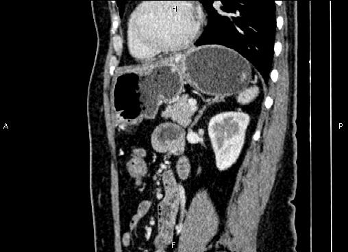 Bilateral benign adrenal adenomas (Radiopaedia 86912-103124 E 65).jpg