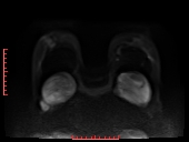 File:Bilateral breast implant rupture (Radiopaedia 24761-25027 DWI 21).jpg