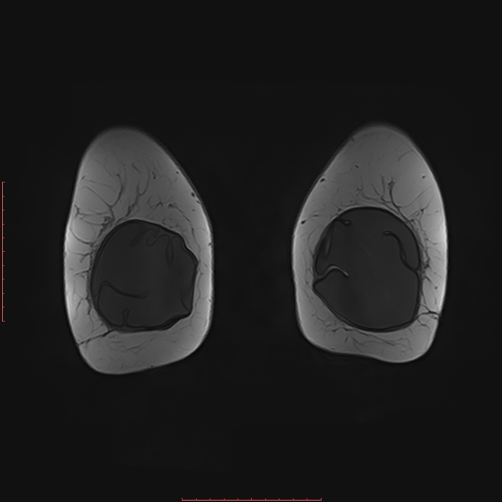 Bilateral breast implant rupture (Radiopaedia 24761-25027 G 88).jpg