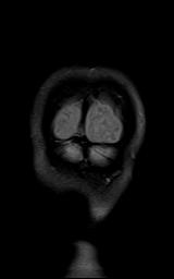 File:Bilateral carotid body tumors and right jugular paraganglioma (Radiopaedia 20024-20060 Coronal 76).jpg
