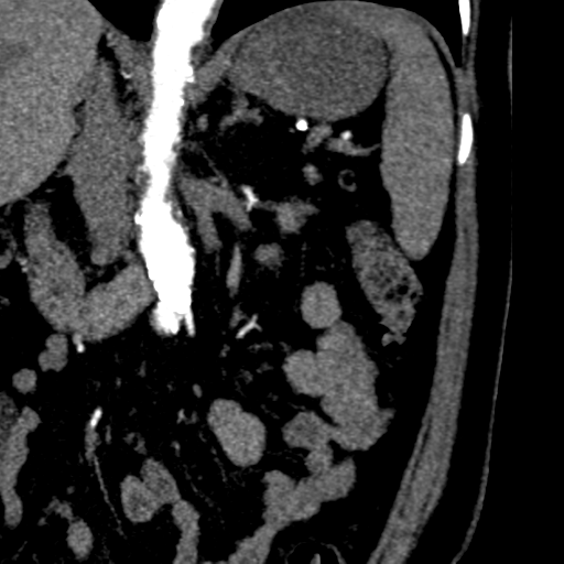 File:Bilateral delayed nephrogram from renal artery stenosis (Radiopaedia 47681-52362 B 6).png
