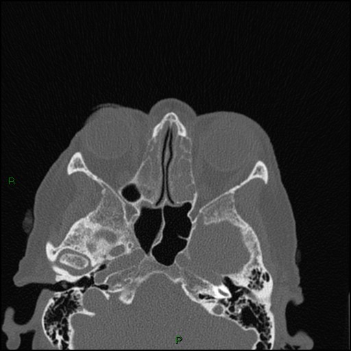 File:Bilateral frontal mucoceles (Radiopaedia 82352-96454 Axial bone window 153).jpg