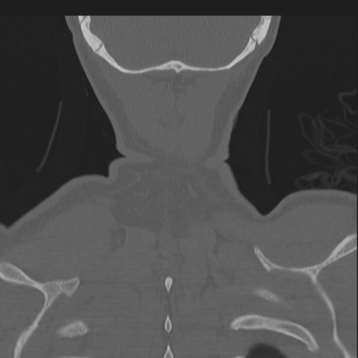 Bilateral locked facets (Radiopaedia 33850-35016 Coronal bone window 84).png