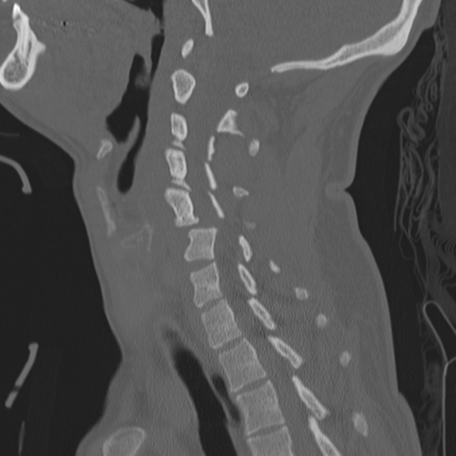 Bilateral locked facets (Radiopaedia 33850-35016 Sagittal bone window 28).png