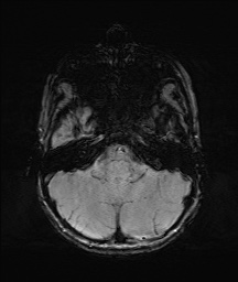 File:Bilateral mesial temporal polymicrogyria (Radiopaedia 76456-88181 Axial SWI 10).jpg
