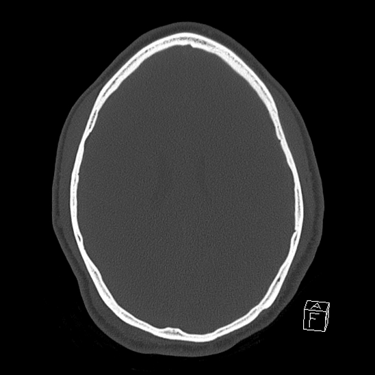 Bilateral occipital condyle fracture (type 2) (Radiopaedia 87675-104089 Axial bone window 88).jpg