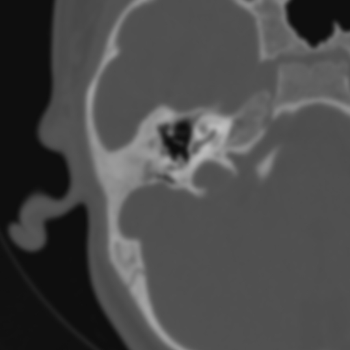 File:Bilateral otosclerosis (Radiopaedia 57237-64157 B 53).jpg