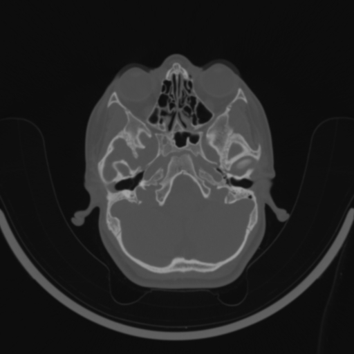 Bilateral otosclerosis (Radiopaedia 57237-64157 C 34).jpg