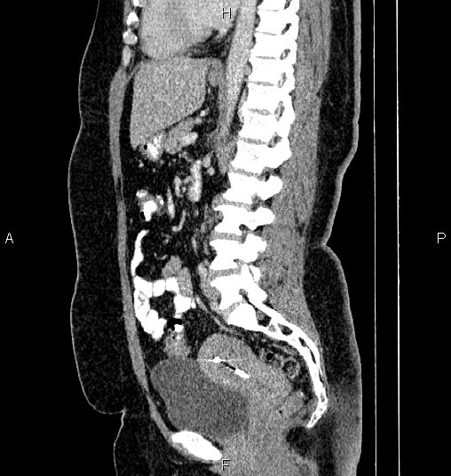 Bilateral ovarian dermoid cysts (Radiopaedia 85785-101603 D 51).jpg