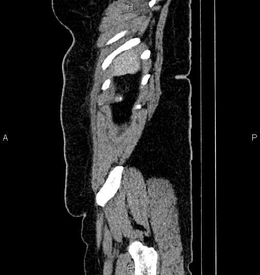 Bilateral ovarian dermoid cysts (Radiopaedia 85785-101603 D 91).jpg