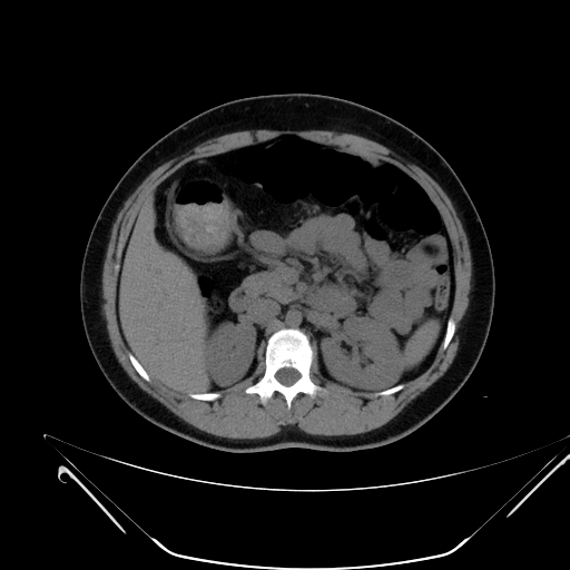 Bilateral ovarian mature cystic teratomas (Radiopaedia 79373-92457 Axial non-contrast 14).jpg