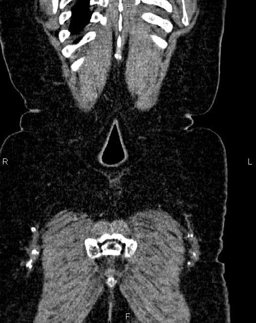 Bilateral ovarian serous cystadenocarcinoma (Radiopaedia 86062-101989 D 55).jpg