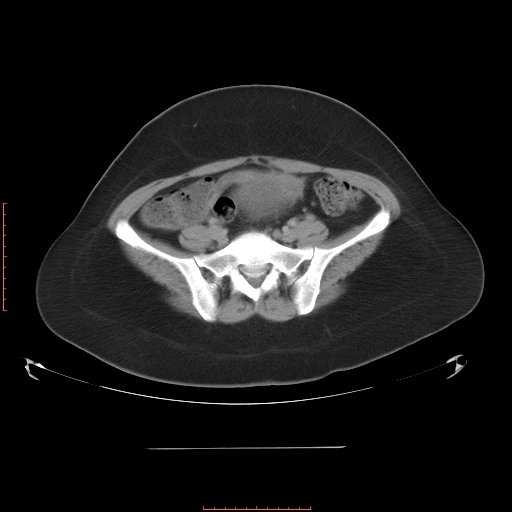 File:Bilateral ovarian serous cystadenocarcinoma with right ovarian torsion (Radiopaedia 32640-33611 A 31).jpg